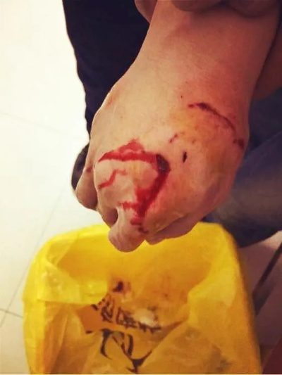 爱犬咬伤脚趾男子宽恕，见证人性光辉新境界