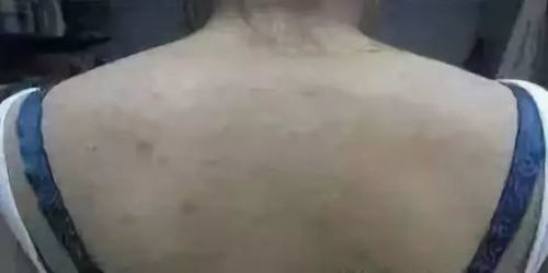 20岁男生惊现“肺洞”之谜，痘痘背后竟隐藏惊人真相！