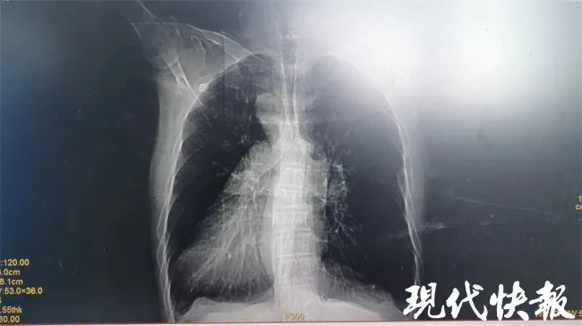 男子胸部脓液X光现刀留体内8年，奇迹避心脏血管惊现新疗法
