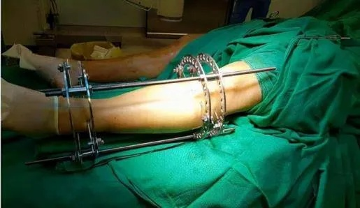 断骨增高术风险大，专家警示：隐蔽宣传死灰复燃，警惕新型医疗陷阱