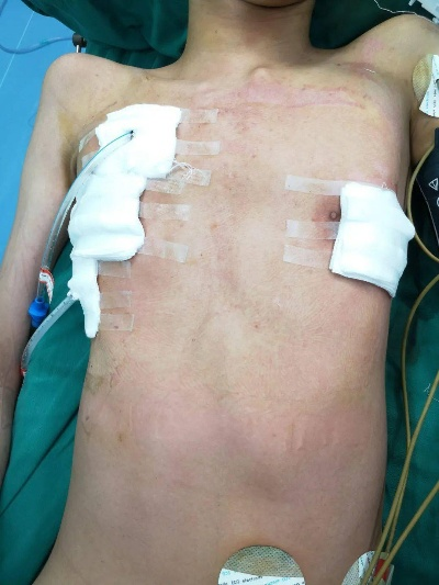 通用降压药引胸部发育异常，男性缩胸手术需求激增，健康风险需警惕