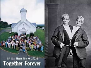 连体双胞胎分离奇迹变悲剧，生命奇迹见证新挑战