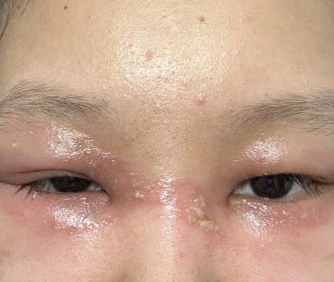 脸被隐翅虫毁容了？熬夜冲分党必学的急救+避坑手册