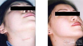 甲状腺疤痕变美丽微笑线，冯提莫展现独特魅力