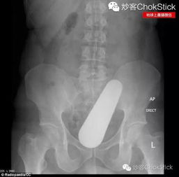 男子直肠惊塞一战炮弹，防爆精英紧急救援！