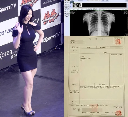 日本写真偶像胸腔X光照片引热议