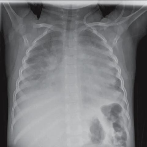 日本写真偶像胸腔X光照片引热议