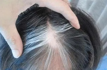 别被广告骗了！专家明确说白发无法逆转