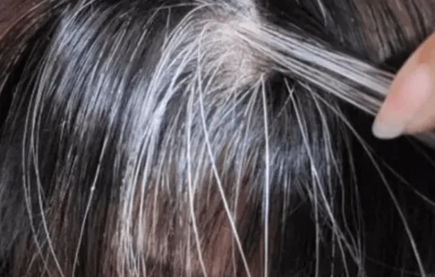29岁女子13岁开始长白发 现在坦然接纳“银白发色”