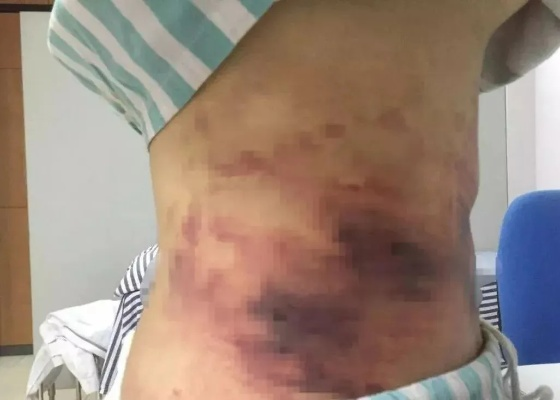 女子花10万做折角腰整形 醒来后浑身血水