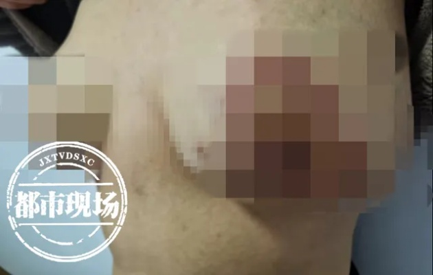 53岁女星因"隆胸"毁容！填充物破裂并渗漏