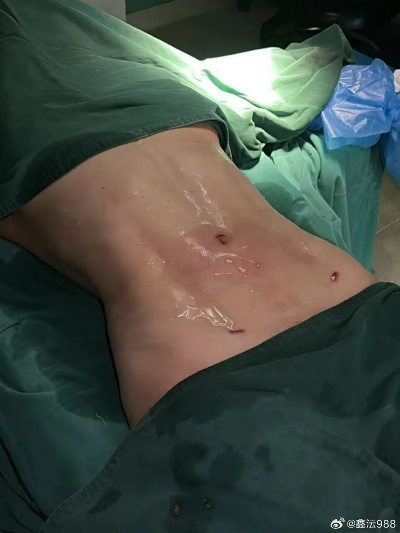 女子花10万做折角腰整形 醒来后浑身血水