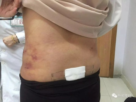 女子花10万做折角腰整形 醒来后浑身血水