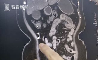 小伙腹痛CT查出肠道卡2把勺子 称吃东西时不慎吞下