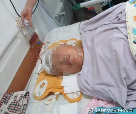 男子4.5米高坠后感染超级细菌：高烧不退脑脊液浑浊像果冻