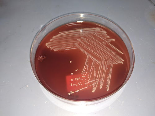 男子4.5米高坠后感染超级细菌：高烧不退脑脊液浑浊像果冻