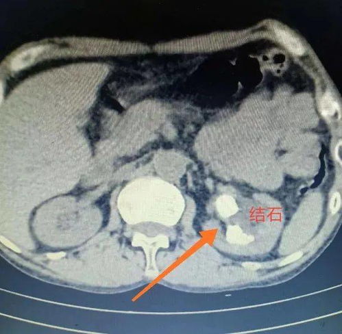 医生分析王炸姐直播时离世：可能是颅内动脉瘤破裂脑干出血