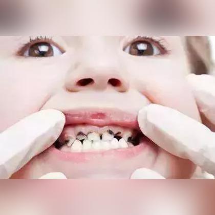 睡觉前才刷牙是错误的？医生：很多人都在无效刷牙