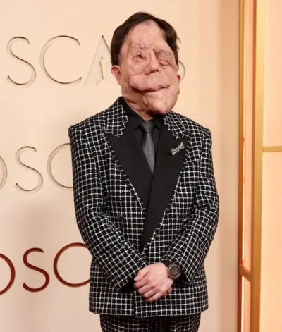 残障演员面部布满肿瘤！走红毯遭同行嘲笑后回击