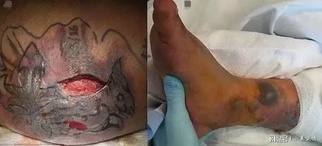 谁是下一个？纹身师晒顾客感染者咬痕纹身