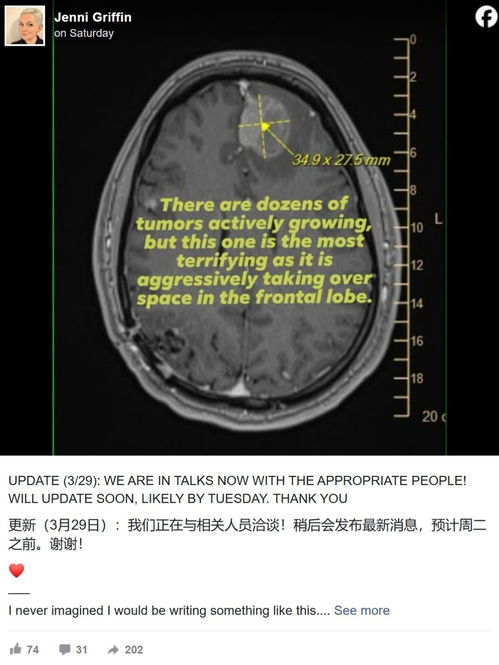 末期脑癌员工遭Epic裁员 CEO回应会为其解决保险问题